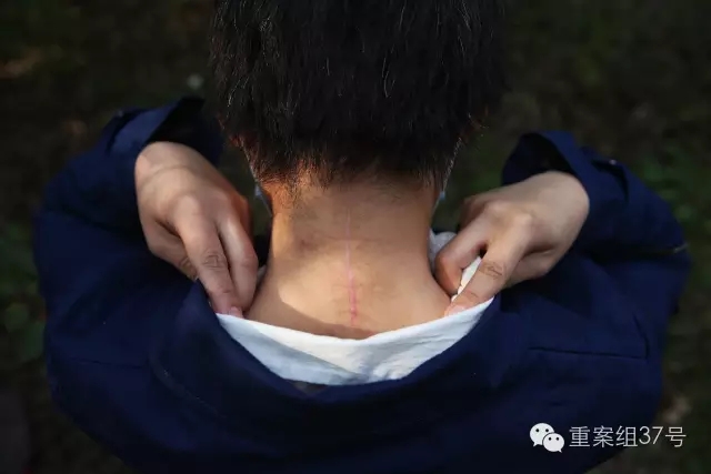八达岭老虎伤人事件伤者赵女士展示伤口。新京报记者薛珺摄